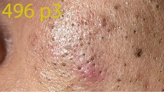 Make your Acne Treatment Huong Da Nang496  acne 2022 Part3 [upl. by Oilcareh]