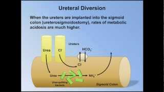 Normal Anion Gap Metabolic Acidosis ABG Interpretation  Lesson 9 [upl. by Swanhildas]