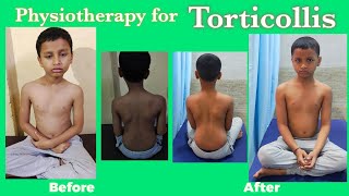 Torticollis Physiotherapy treatmentWry Neck Exercises Torticollis stretching exercises [upl. by Hime]