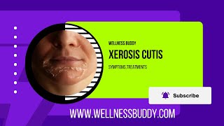 Xerosis Cutis Severe Dry Skin Calluses and Fissures [upl. by Ydnahs519]