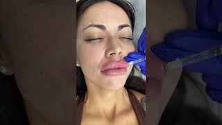 Lips Filler Treatment by our Cathy  Ageless MD [upl. by Latea]