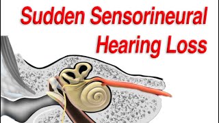 Sudden Sensorineural Hearing Loss Diagnosis Causes and Treatment [upl. by Eceinart285]