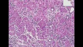 Histopathology Esophagus Herpes esophagitis [upl. by Iat]