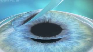 LASIK Vs ReLEx SMILE [upl. by Shellie]