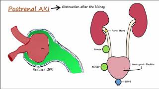 Acute Kidney Injury AKI  PrerenalIntrarenalPostrenal [upl. by Nivar]