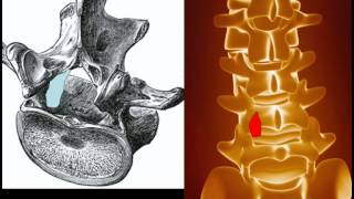 Behandlung der Spinalkanalstenose [upl. by Killion]