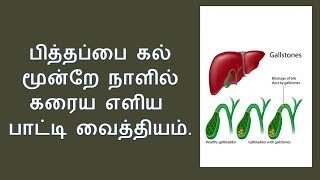 பித்தப்பை கல் கரைய  Home remedies for gallstones in tamil  NV [upl. by Aihseuqal]