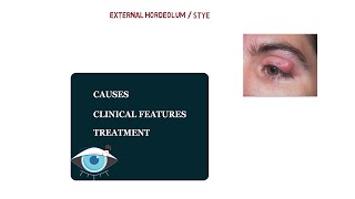 STYE  CLINICAL FEATURES  TREATMENT [upl. by Erelia]