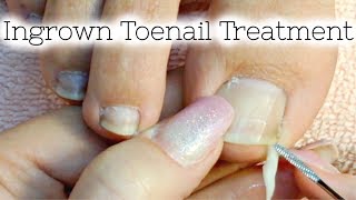 Pedicure Tutorial Ingrown Toenail Treatment At Home How to Recut Nail Groove to Eliminate Pain [upl. by Hefter826]