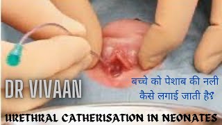 Urethral Catheterisation In Male Neonate  How To Apply Urinary Catheter In Newborn  पेशाब की नली [upl. by Swanhildas588]