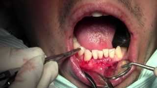 Alloderm Gingival Grafting 262524 Sling Suturing of Native Tissues [upl. by Benedic214]