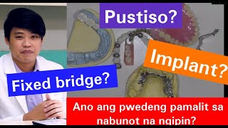 Nabunutan Anu ang Mga Puwedeng Pamalit sa Nabunot ng Ngipin Pustiso Bridge Jacket Implant 19 [upl. by Karol830]