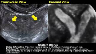 Congenital Uterine Anomalies Ultrasound Reporting  Didelphys Bicornuate Unicornuate Uterus USG [upl. by Jade]