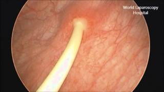 Removal of Double J stent by Cystoscopy [upl. by Dimitry918]