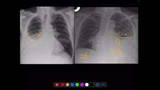 Radiografía de torax  Distinguir Hemothorax VS derrame pleural [upl. by Dryden448]