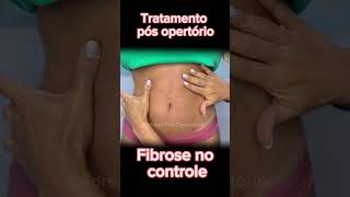 Fibrose pós lipo cadrena pósoperatório lipo lipohd fibrosis flacidez antesedepois estetica [upl. by Artsa]