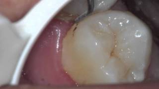 Severe Gingivitis [upl. by Rim]