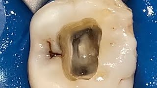 Maxillary Molar Access Cavity Preparation Part 5 [upl. by Anyrtak]