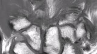 Avascular necrosis lunate bone Kienbocks Disease [upl. by Hutson300]