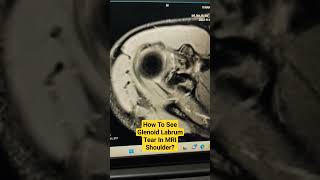 How To See Glenoid Labrum Tear In MRI Shoulder drsaichandra shouldermri [upl. by Aicelef]