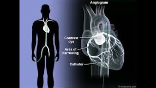 Coronary Arteriography  Coronary Angiography  Definition Procedure Uses Benefits [upl. by Corina]