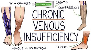 Understanding Chronic Venous Insufficiency [upl. by Eannej]