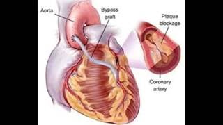 Comment repérer les symptômes de la maladie coronarienne [upl. by Araed]