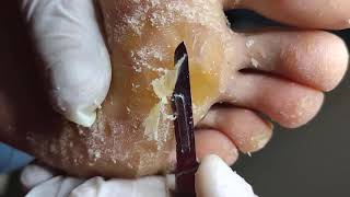 Removing Extremely Hard Foot Callus 🦶 The right way to remove foot callus FULL TREATMENT 04 [upl. by Zippora522]