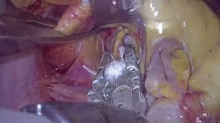 Totally Endoscopic Approach Left Atrial Appendage Clipping via Transverse Sinus [upl. by Ian542]