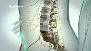 Rückenmarkstimulation bei chronischen Schmerzen Spinal Cord Stimulation SCS [upl. by Rapsag620]