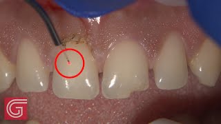 HOW TO Use Picasso™ Lite Dental Laser for Gingivectomy [upl. by Broome]