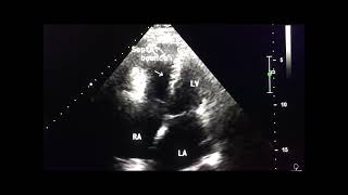 Constrictive pericarditis in echo to drahmadmirdamadisieOUTsC1dOD8fuygn [upl. by Fiester]