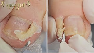 🤤😱UMA HORA DE REMOÇÃO COM PEELING satisfying [upl. by Anitsugua]