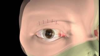 Thyroid eye disease  14 Lid surgery  The operation [upl. by Esened622]