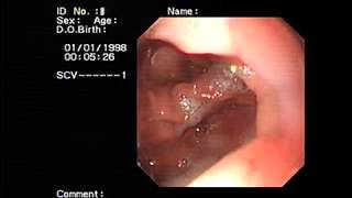 Gastric mucosal prolapse [upl. by Dusen]