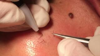 Electrolysis hair removal close up [upl. by Louis]