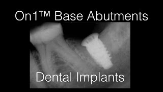 On1™ Abutment • New Video about Features [upl. by Ahsinyt]