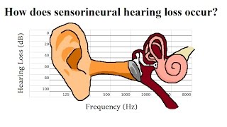 How Does Sensorineural Hearing Loss Occur [upl. by Tybald]