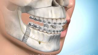 Chirurgische kaakcorrectie onder en bovenkaak [upl. by Hawger]