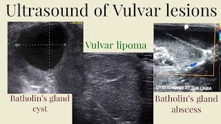 Ultrasound of Vulvar lesions Batholins gland cyst vulvar lipoma  Batholins gland abscess [upl. by Jannel]