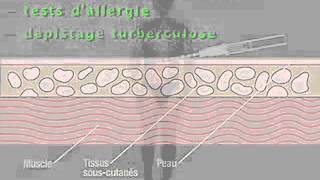 injection intradermique [upl. by Nadual]