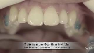 Orthodontie Invisible Strasbourg  Traitement par Gouttières  Dr Eric URSAT [upl. by Arteid]