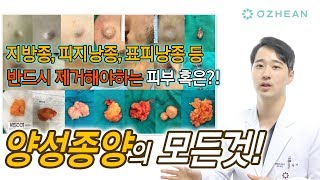 양성종양혹 종기 지방종 피지낭종 표피낭 모낭종 제거에 대하여 단 한번에 정리해드립니다 성형 알려주는 남자 이용석 [upl. by Doralyn]