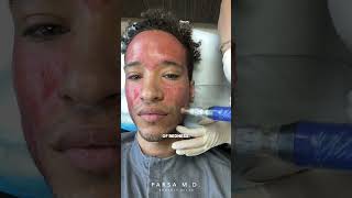 Microneedling with PRP for Acne Scars  Kami Parsa MD skincare acnescars [upl. by Pentheam]