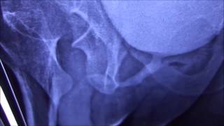 Micturating Cystourethrography MCU or Voiding Cystourethrogram [upl. by Jo Ann553]