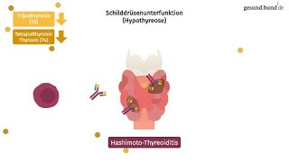 Welche häufigen Schilddrüsenerkrankungen gibt es [upl. by Andrus]