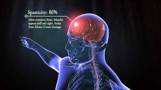 Types of cerebral palsy [upl. by Atinnor]