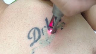 Tattoo Removal using Spectra Laser  Los Angeles Skin Perfect Brothers [upl. by Arathorn]