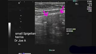 Spigelian hernia ultrasound video [upl. by Martz]