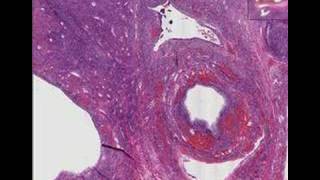 Histopathology Ovary Polycystic ovarian disease SteinLev [upl. by Ived279]